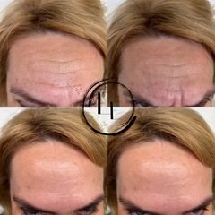 Botulotoxín čelo + glabella