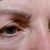 Blepharoplastika, MUDr. Bumbera, Bratislava, spokojnosť s výsledkom, odporúčam 