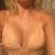 375 ml, okrúhle implantáty, Eurosilicone, vysoký profil